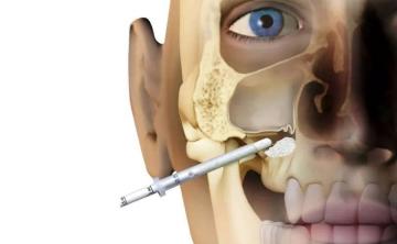 Bone plasty in dentistry