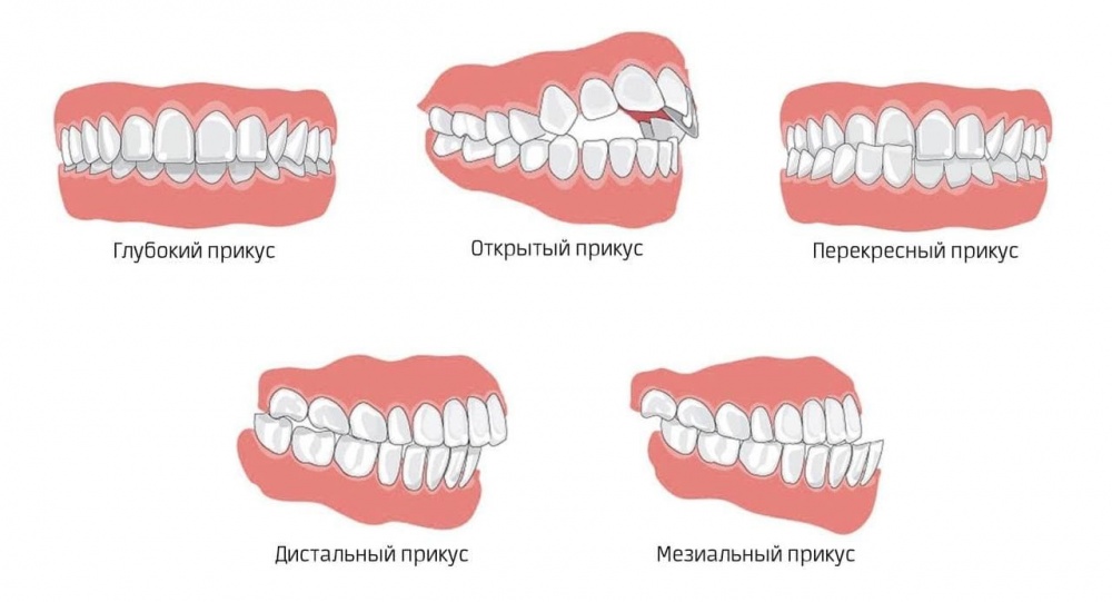 Неправильний прикус